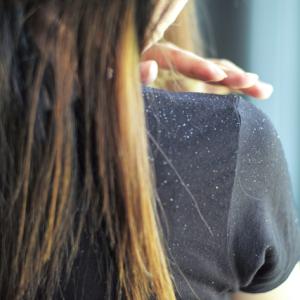 Dandruff Treatment: How to Restore a Healthy, Flake-Free Scalp Naturally